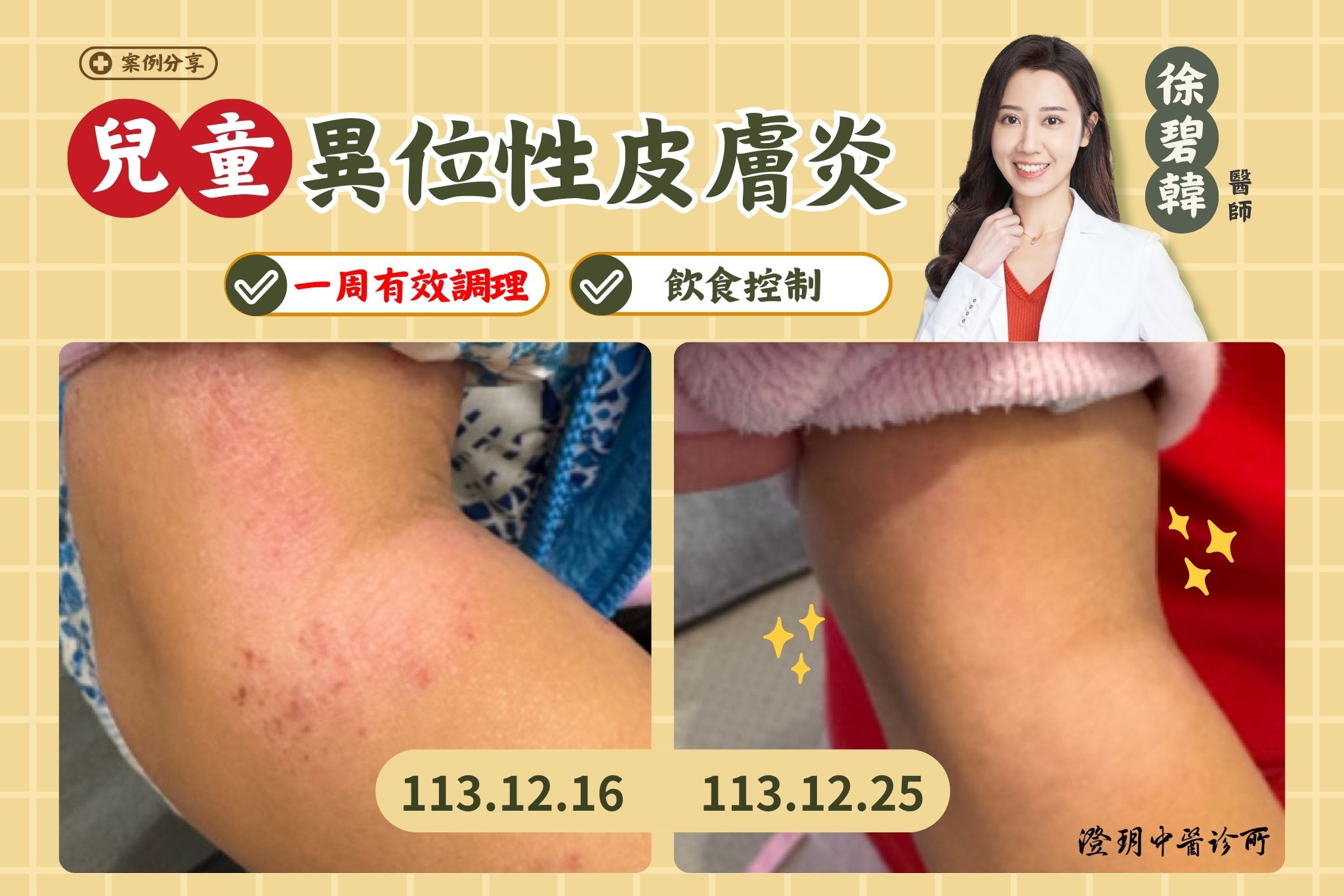 250111_atopic dermatitis_AD_case_cover